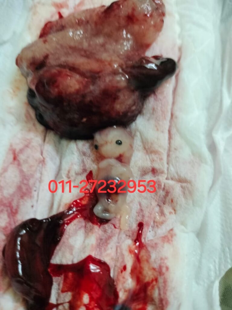 Pendarahan serta ketulan selepas makan pil gugur